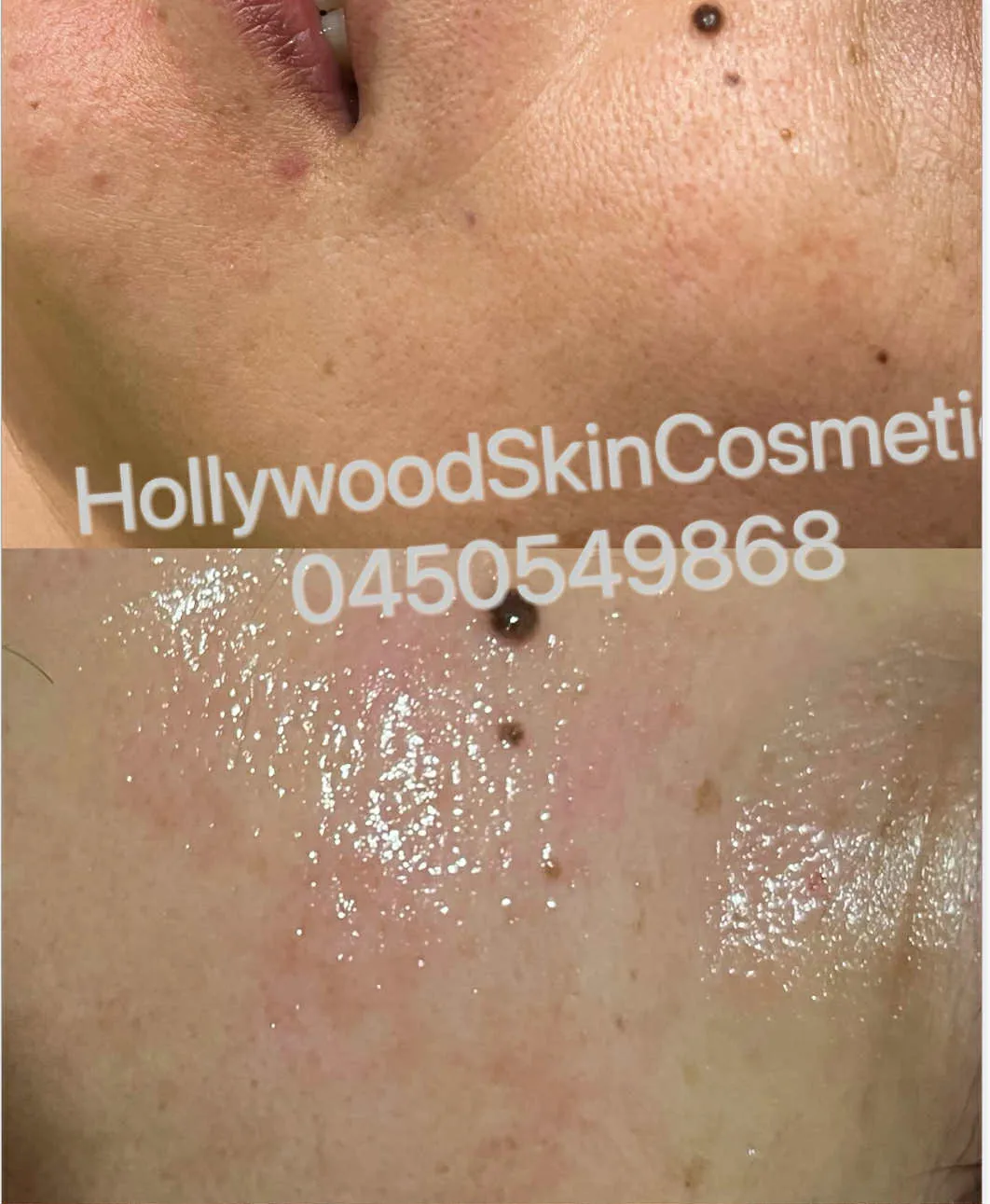 The same area of a client cheek photographed twice, before dermaplaning above and immediately after below