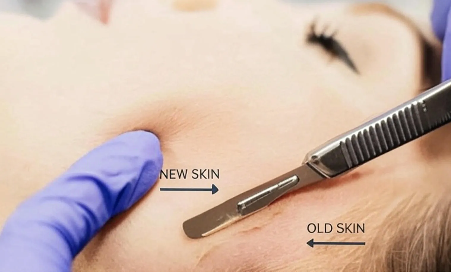 An illustration of a dermaplaning blade lifting away old skin to reveal new skin beneath