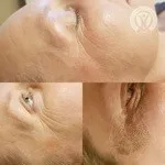 Close views of the skin around the eye during a course of treatment