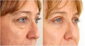 The same client photographed twice from the same angle, upper eyelids before and after treatment