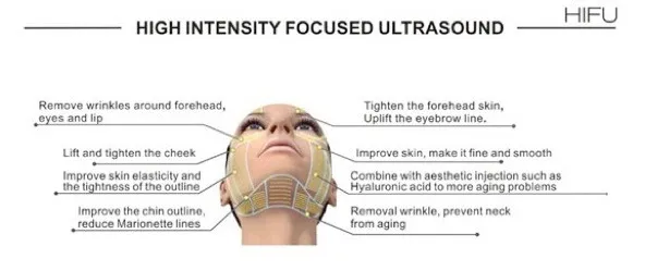 A diagram of a face showing where high intensity focused ultrasound is used