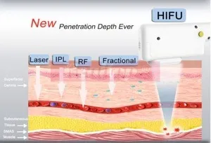 A cross section of skin comparing how deep laser, IPL, radio frequency, fractional and HIFU energy reach