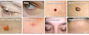 A labelled chart of the skin irregularities the Lamprobe treats: fibromas on the face, milia, raised angioma, raised fibroma, skin tag with stalk, spider naevi, xanthelasma and clogged pores