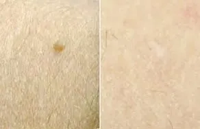 Skin with a raised mole, photographed again after Lamprobe treatment