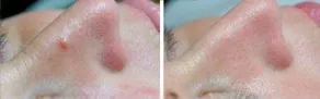 Skin around the nose with milia, photographed again after Lamprobe treatment