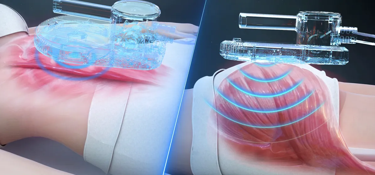 An illustration of the applicator over muscle tissue, with electromagnetic waves reaching into the muscle beneath