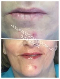 Lips photographed before cosmetic tattooing above and after below